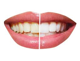 Teeth Whitening in Sharjah