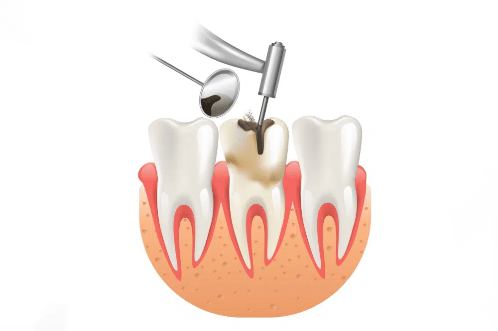 Dental Fillings in Sharjah