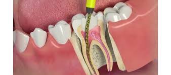 Root Canal Treatment 


